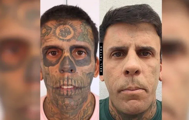 Sintomas Urinários Revelam Tumor na Bexiga em Homem Mais Tatuado