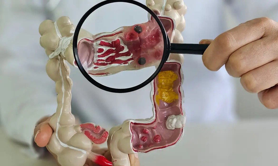 Ultraprocessados entram no alerta sobre doenças intestinais